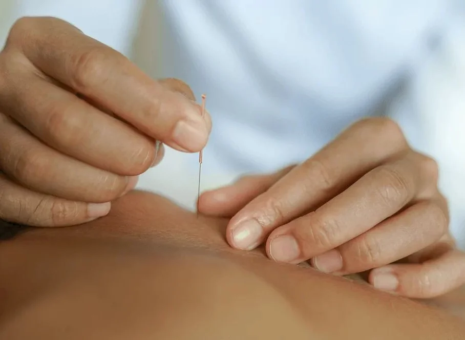 Dry needling