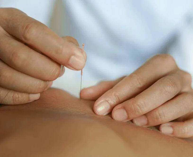 Dry needling